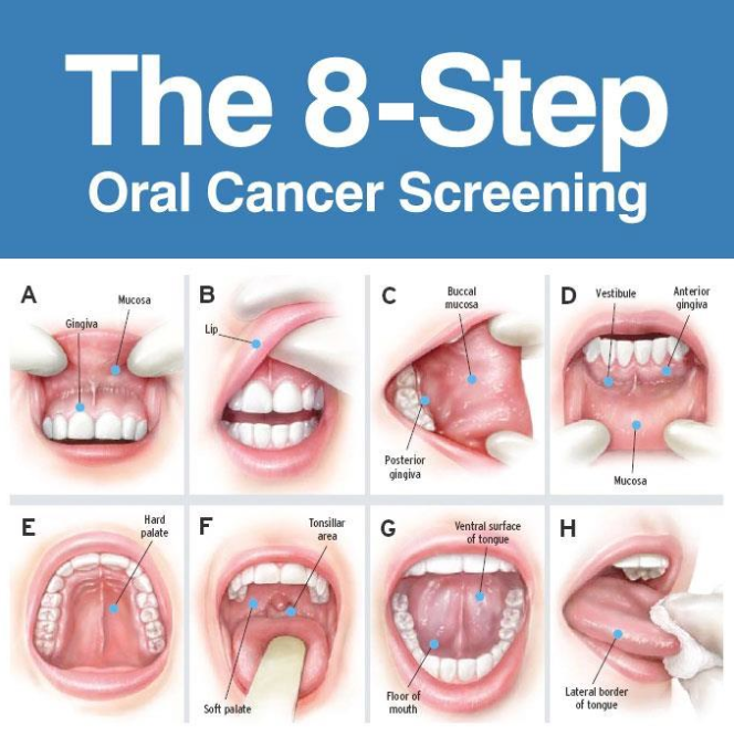 8 Step Oral Cancer Screening