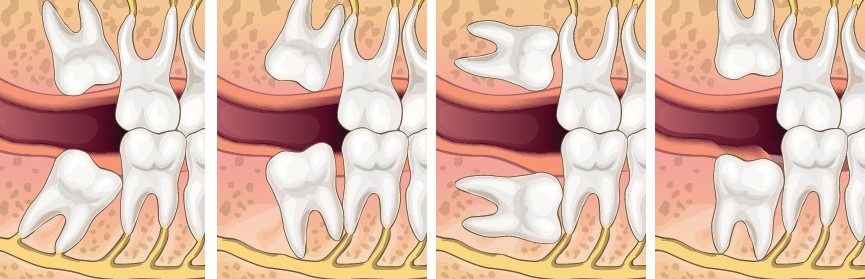 The Facts About Wisdom Teeth How Many Uncovered